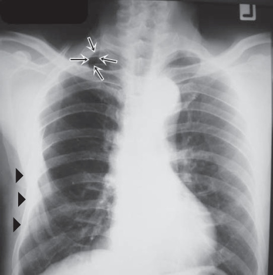 Unrecognized Hemo-Pneumothorax from Major Chest Injury ...