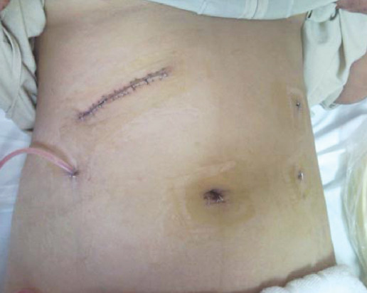 whipple procedure scar